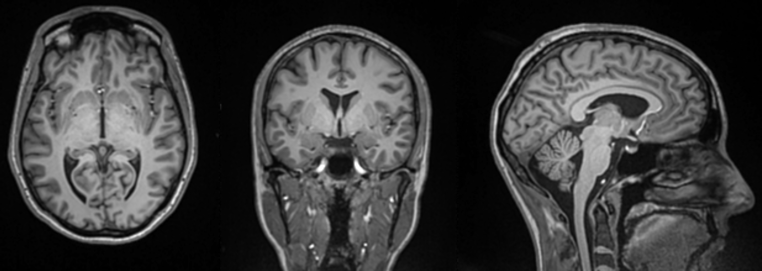 A black and white MRI photo of three brains