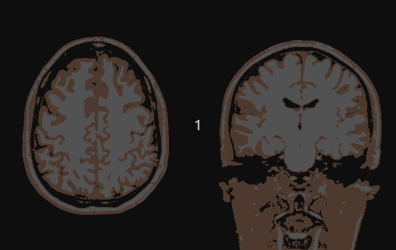 Two MRI brain images in black and white